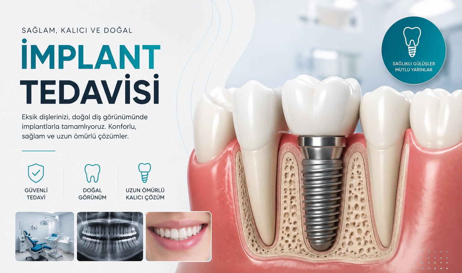 Dijital İmplant Planlaması